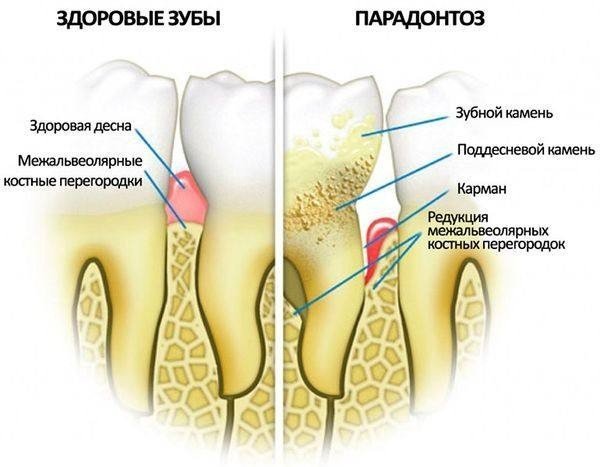 Здоровый корень зуба